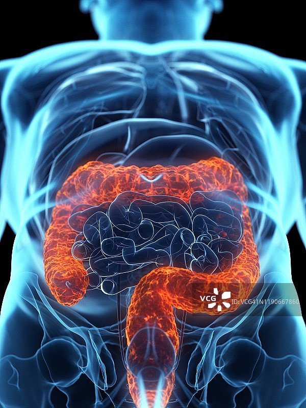 病变的结肠概念图图片素材