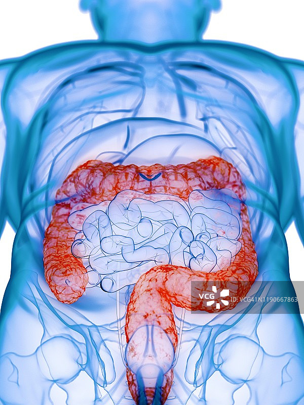 病变的结肠概念图图片素材
