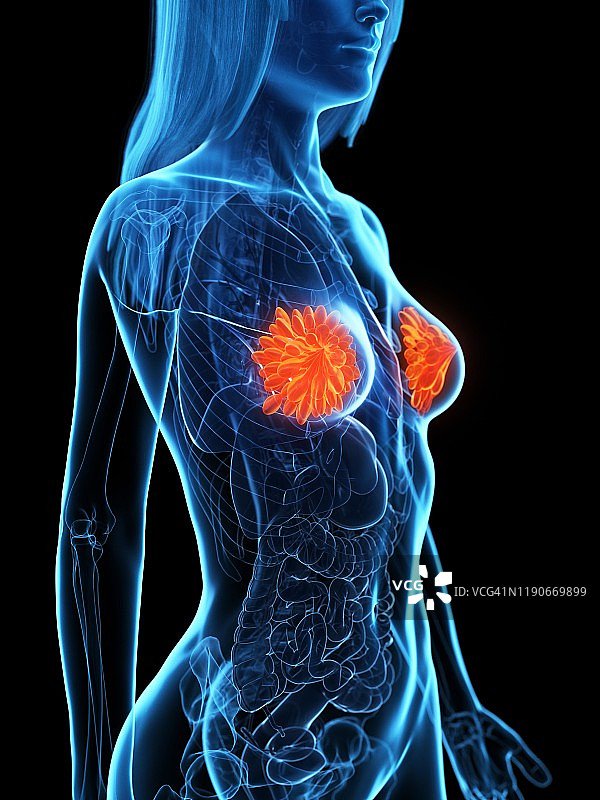 乳腺疾病概念图图片素材
