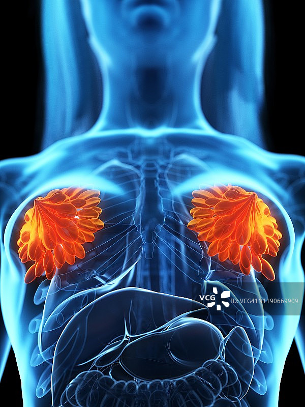 乳腺疾病概念图图片素材