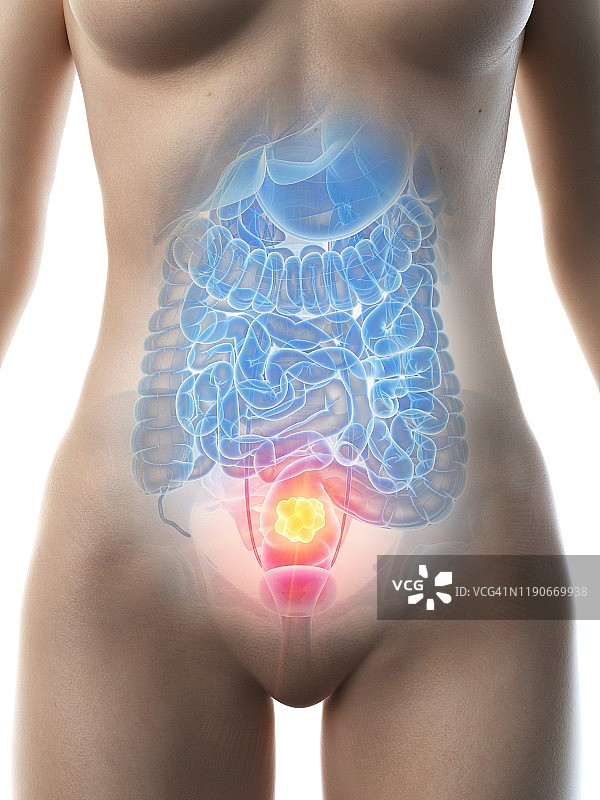 结肠癌概念图图片素材
