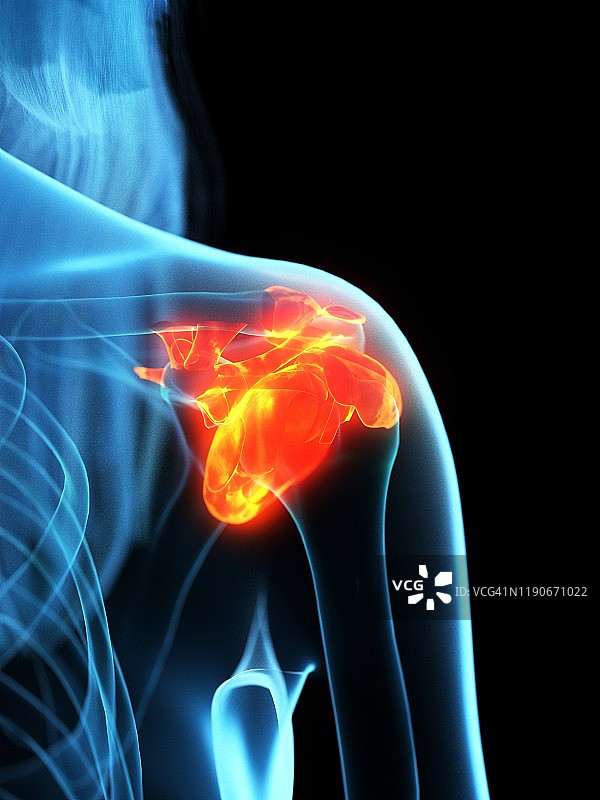 发炎的韧带概念图图片素材