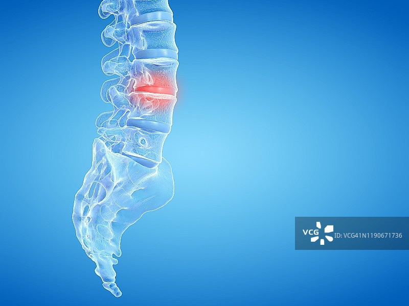 背部疼痛，概念说明图片素材