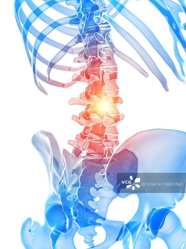 腰痛概念图图片素材