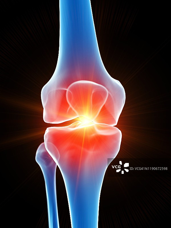 膝盖疼痛概念图图片素材