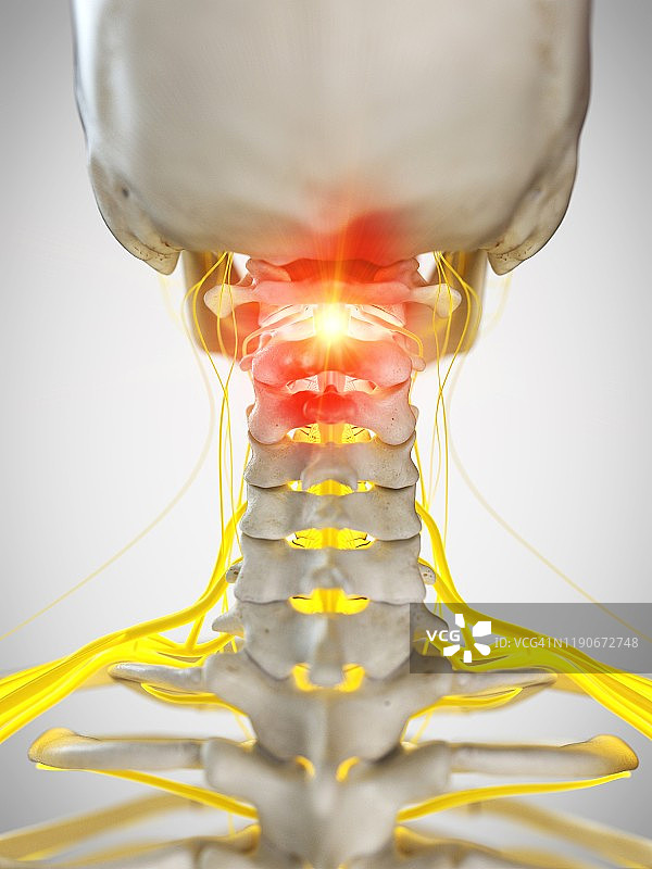 颈部疼痛概念图图片素材