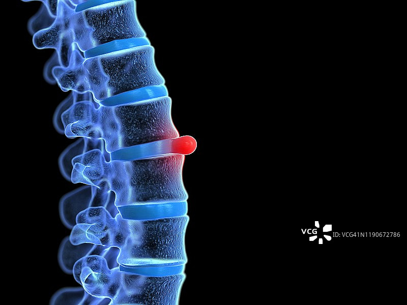 椎间盘突出示意图图片素材