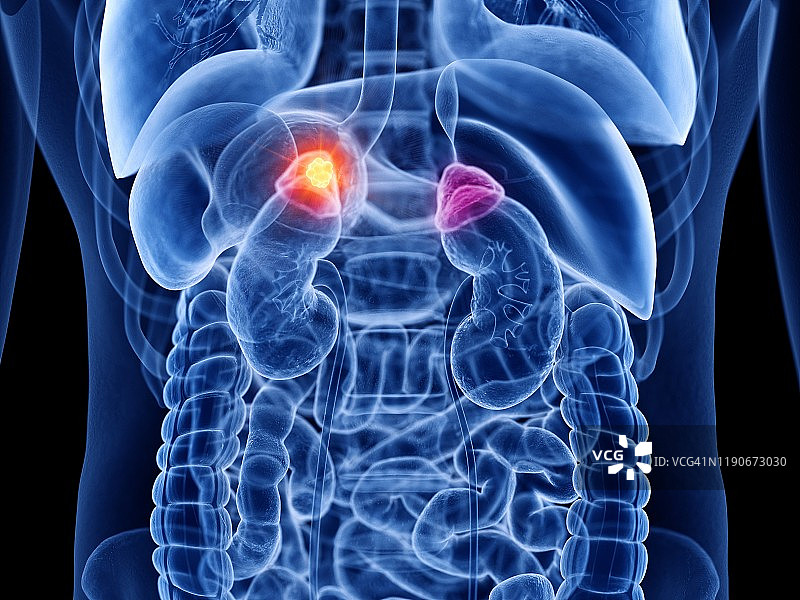 肾上腺癌插图图片素材