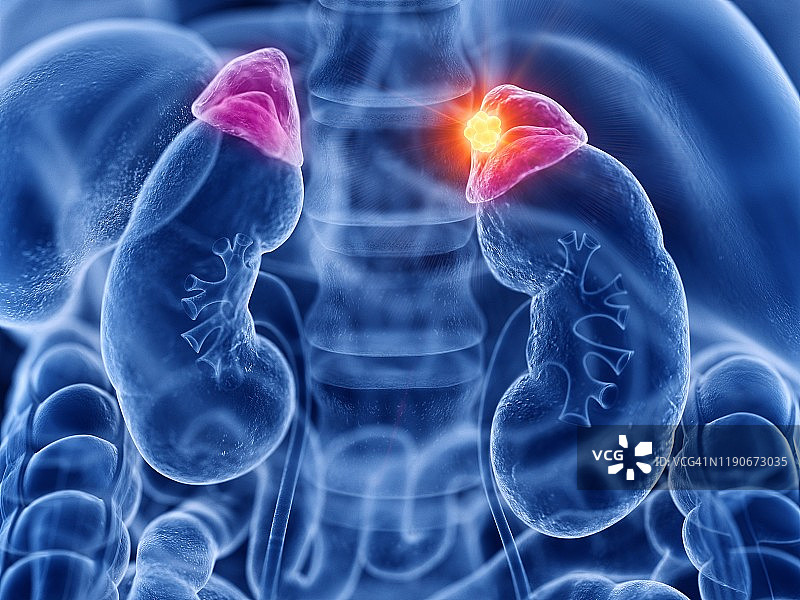 肾上腺癌插图图片素材
