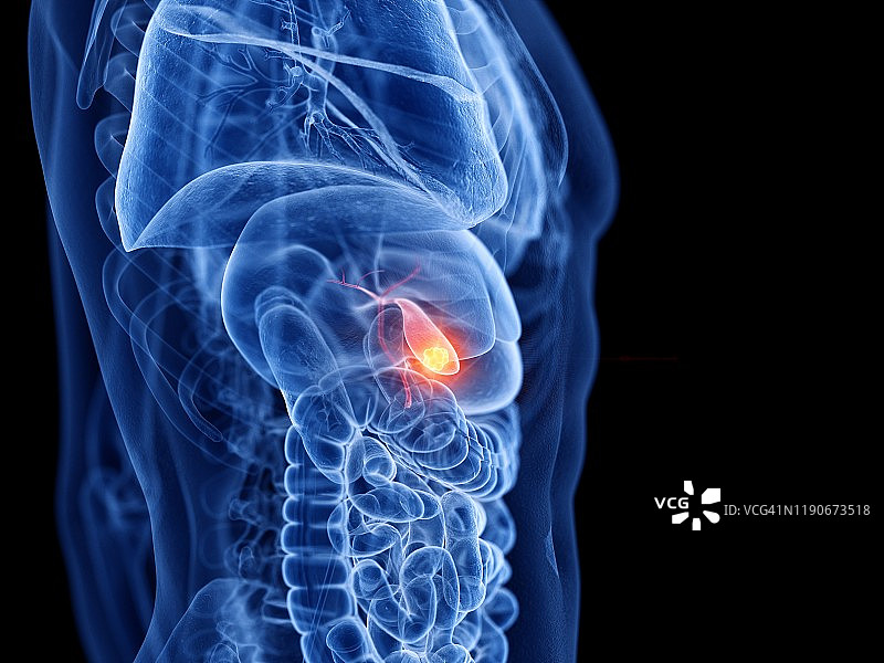 胆囊癌插画图片素材