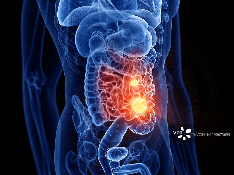 小肠癌插图图片素材