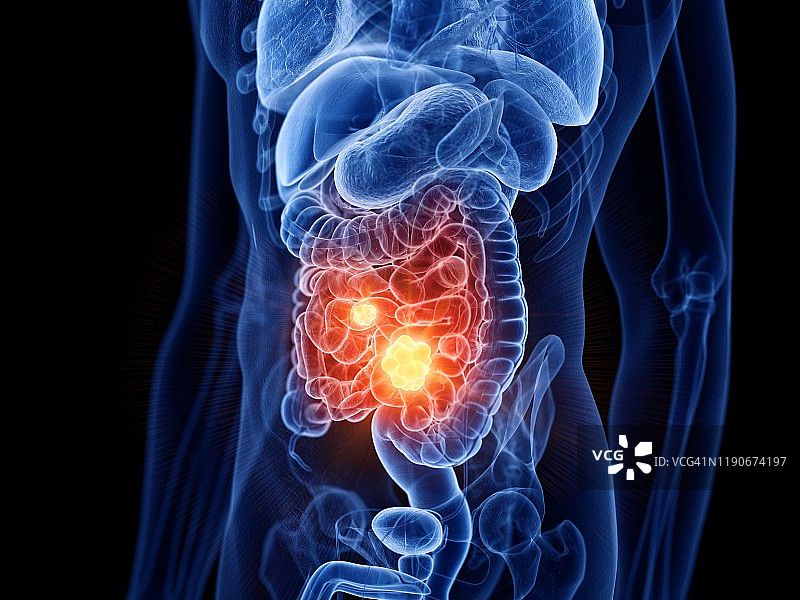 小肠癌插图图片素材
