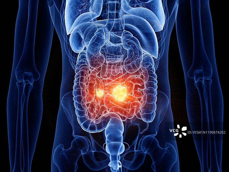 小肠癌插图图片素材