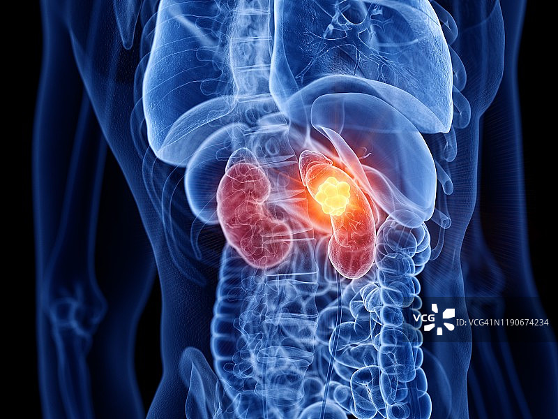 肾癌图示图片素材