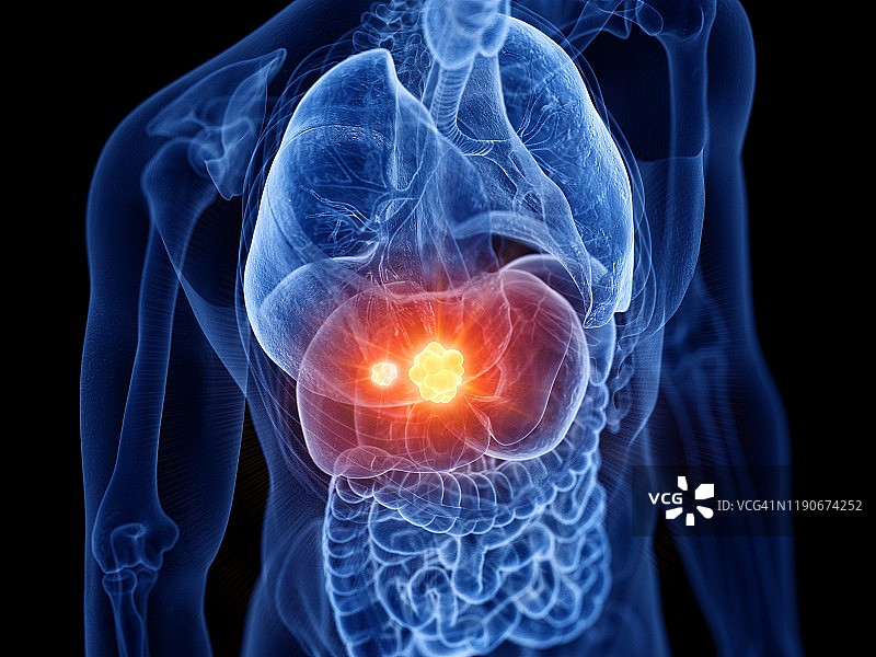 肝癌，图示图片素材