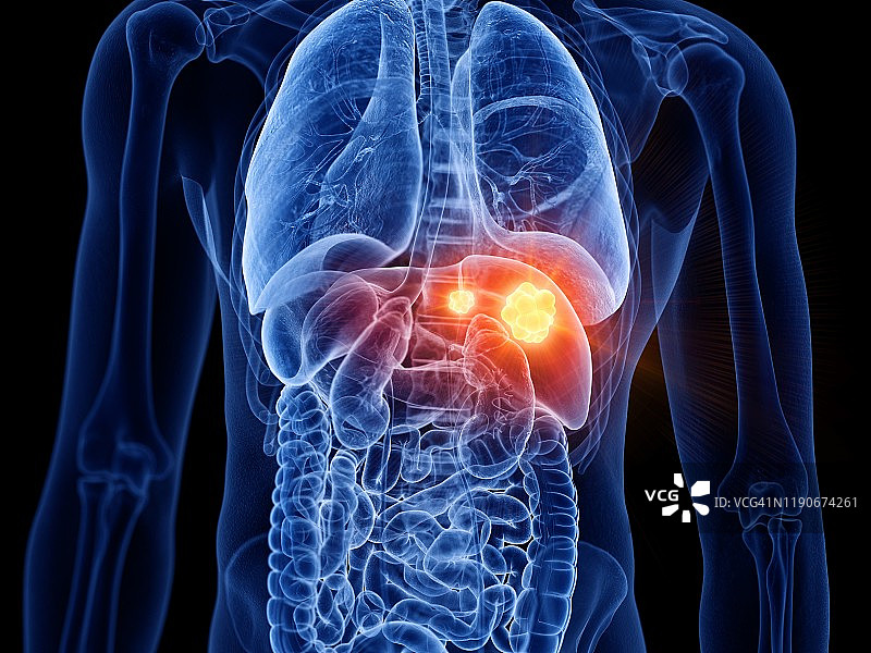 肝癌，图示图片素材
