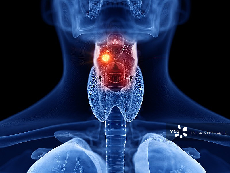 喉癌插画图片素材