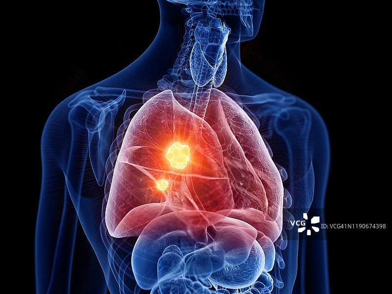 肺癌插图图片素材