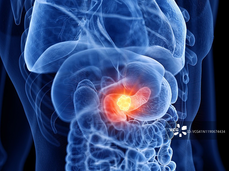 胰腺癌插图图片素材