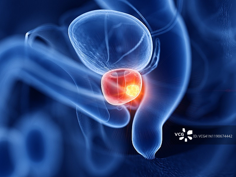 前列腺癌插画图片素材