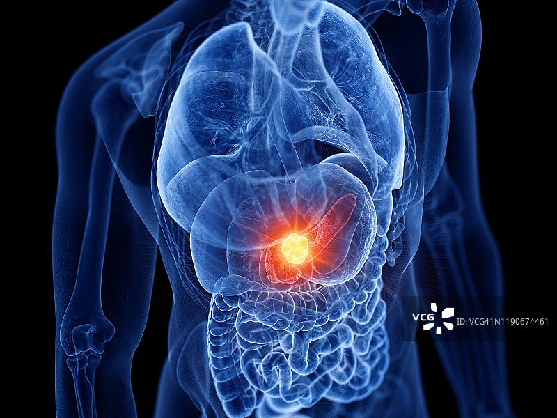 胰腺癌插图图片素材