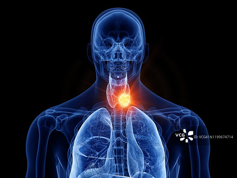 甲状腺癌图示图片素材