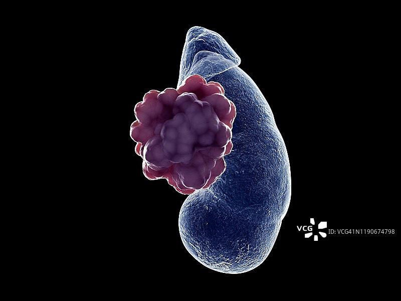 肾脏肿瘤插画图片素材