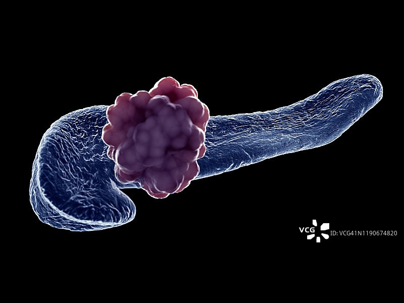 胰腺肿瘤插图图片素材