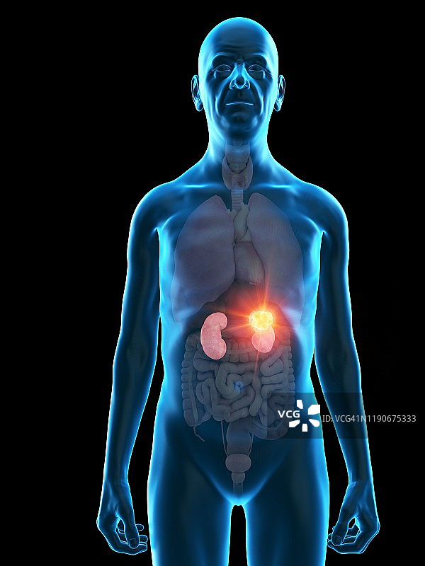 图示:一位老人的肾脏肿瘤图片素材