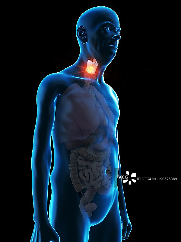 老人喉肿瘤的图示图片素材