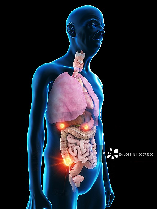 患有肿瘤的年长男人图片素材