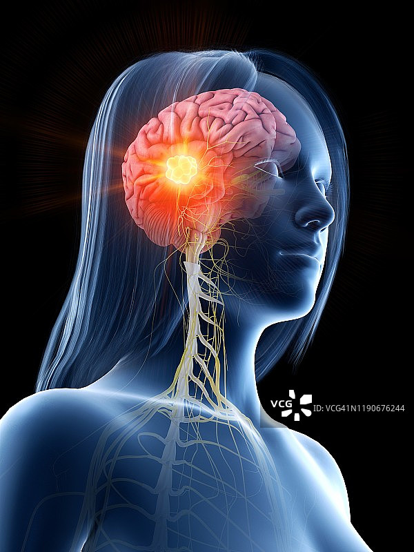脑癌概念图图片素材