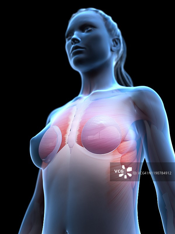 隆胸植入物插图图片素材