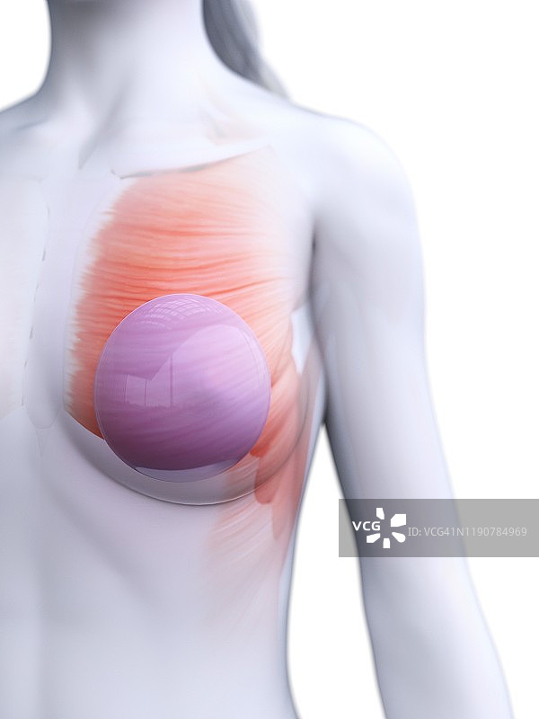 隆胸植入物插图图片素材