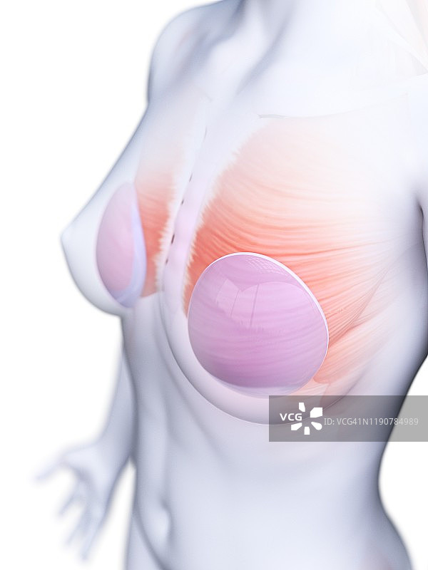 隆胸植入物插图图片素材