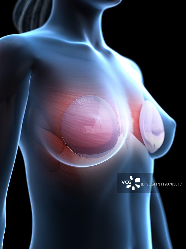 隆胸植入物插图图片素材