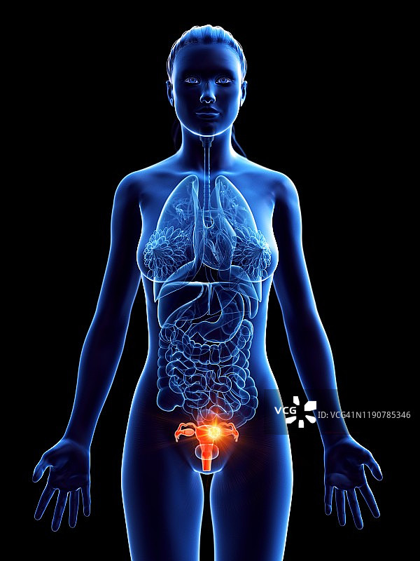 子宫癌概念图图片素材