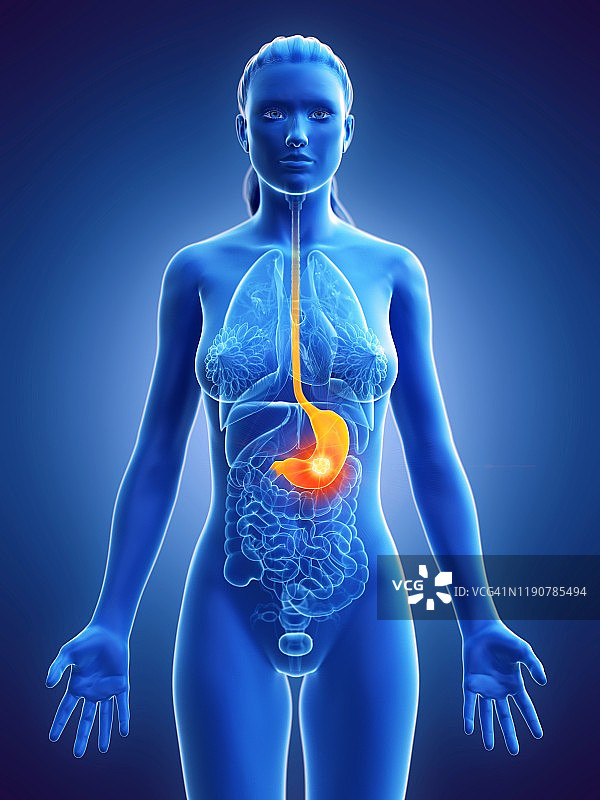 胃癌概念图图片素材