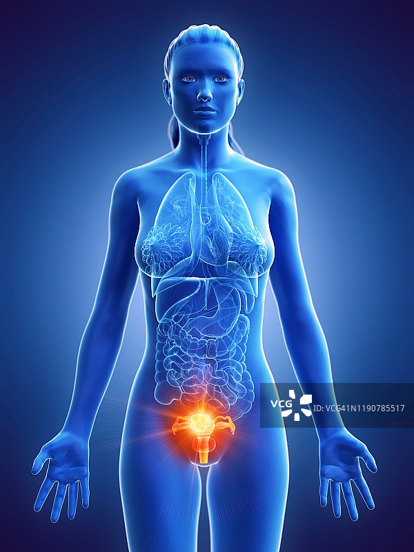 子宫癌概念图图片素材