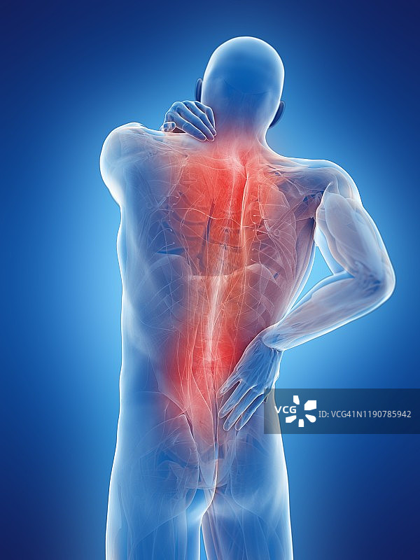 背部疼痛，概念说明图片素材