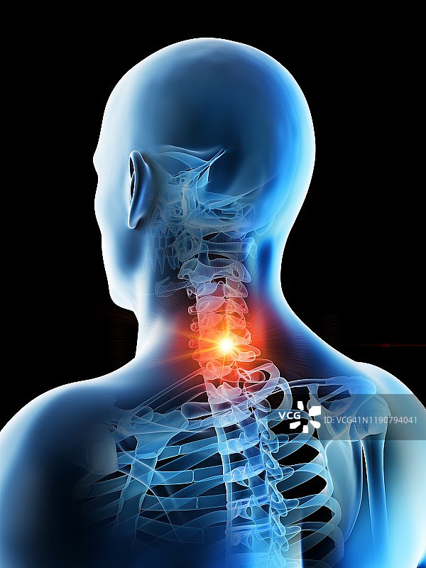 颈部疼痛概念图图片素材