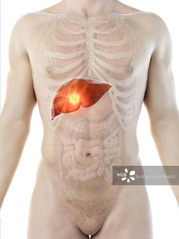 肝癌概念图图片素材