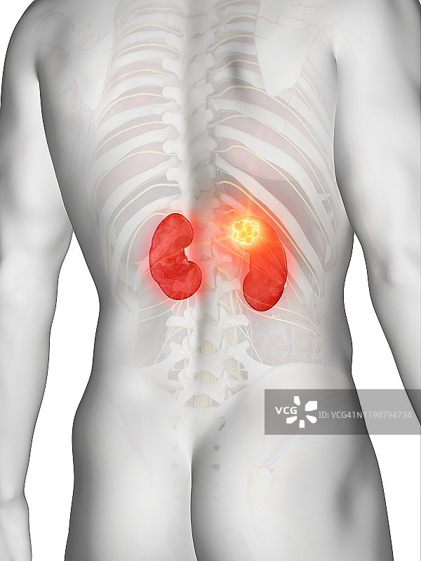 肾癌概念图图片素材