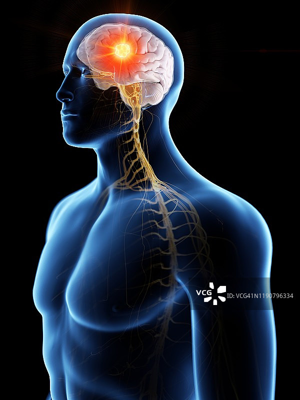 脑癌概念图图片素材