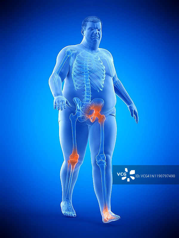 关节疼痛的肥胖跑步者，图示图片素材