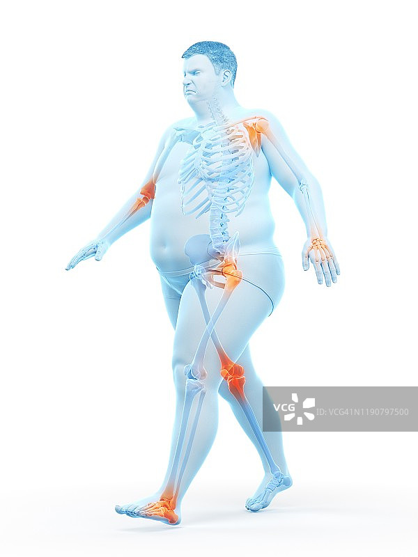 关节疼痛的肥胖跑步者，图示图片素材