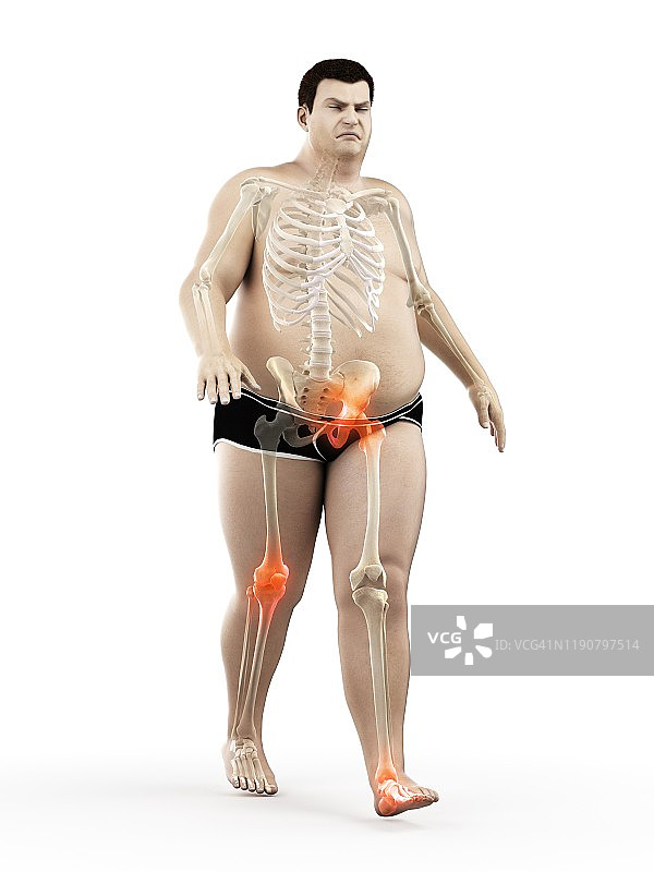 关节疼痛的肥胖跑步者，图示图片素材