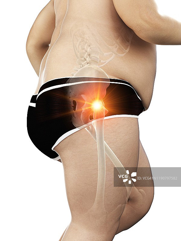 患有髋部疼痛的肥胖跑步者插图图片素材