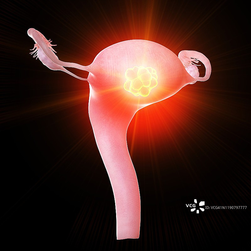 子宫肿瘤概念图图片素材