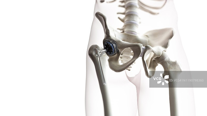 髋关节置换术插图图片素材